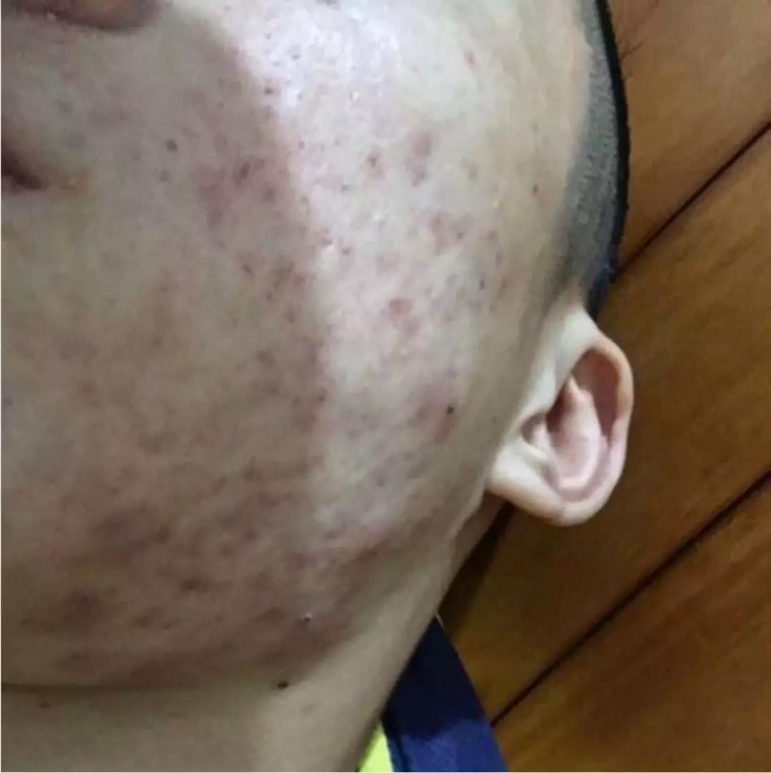 怎么祛痘祛痘印最有效的方法,如何快速祛痘祛痘印小妙招