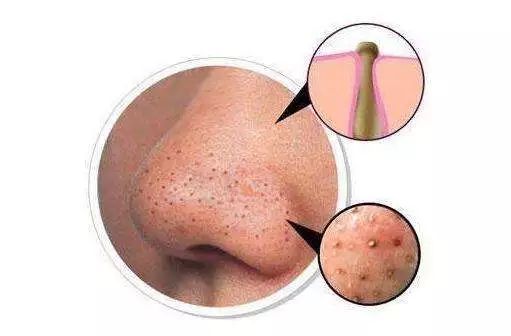 腋下痘痘挤出白色米粒是什么,痘痘里面挤出小米粒是不是就好了