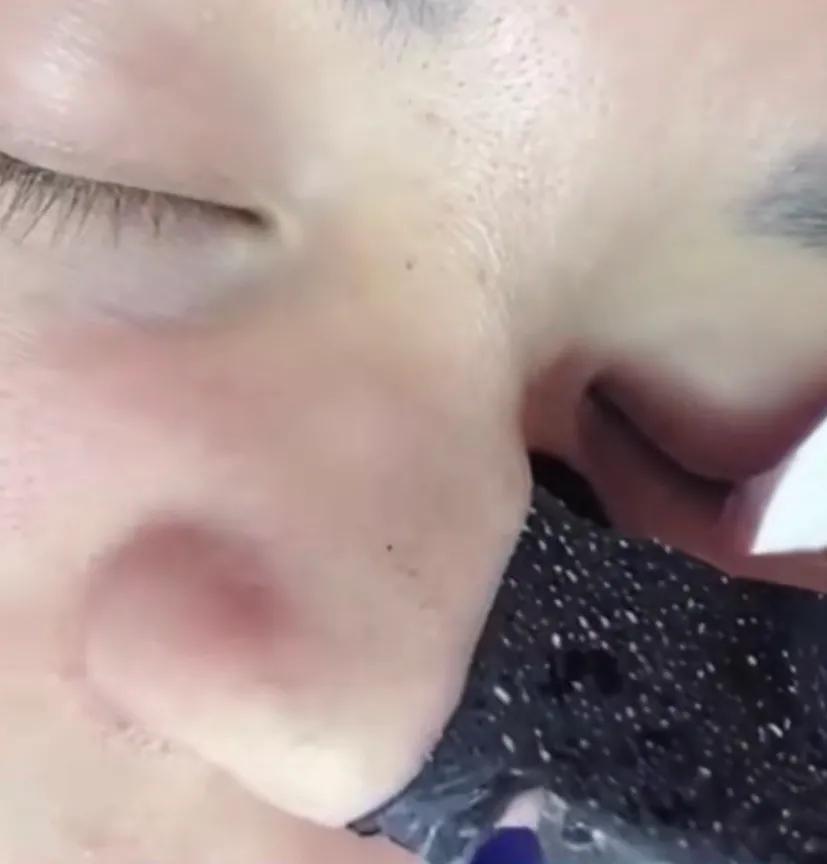 甲硝唑凝胶的使用方法祛黑头,祛黑头最好的方法目前最有效