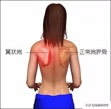 蝴蝶骨中间脊椎有凸起,翼状肩胛为何要加强菱形肌