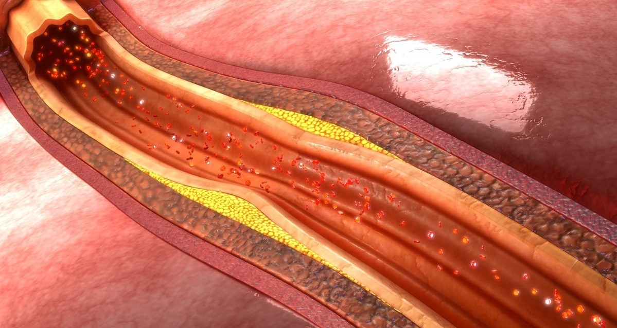 有颈动脉斑块能长期吃他汀类药吗,颈动脉有斑块需要长期吃他汀药吗