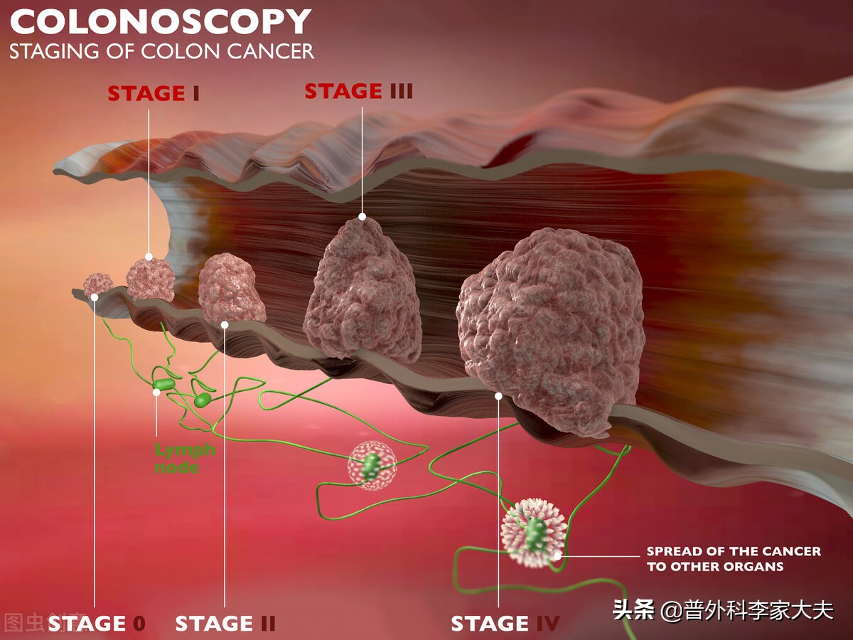 提高肠癌的免疫力吃什么好,提高直肠癌诊断率的简便有效措施