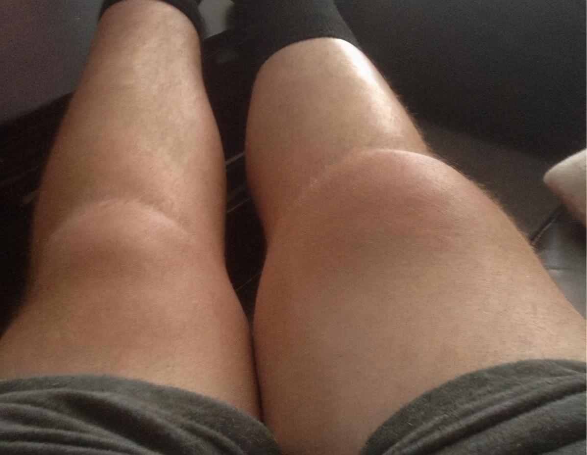 膝关节肿胀是什么原因引起的,膝关节手术后为什么小腿会痛