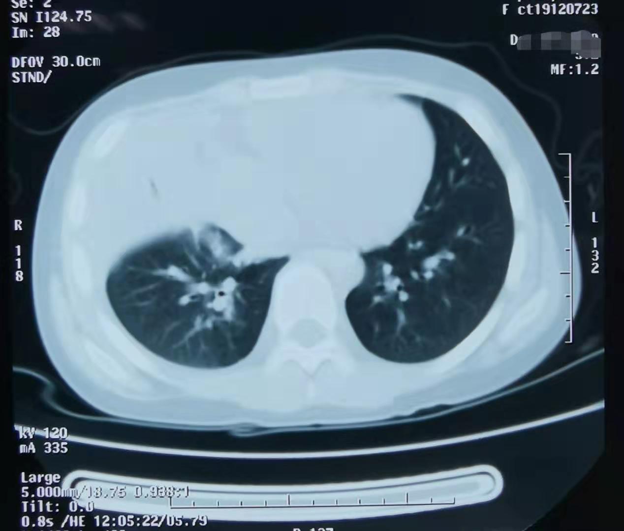 流感还没好利索能喝川贝枇杷膏么,流感还没好又感冒