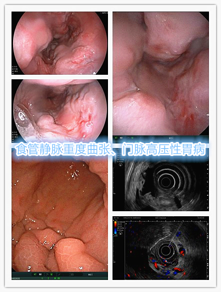 肝硬化引起门脉高压消化道出血,肝硬化消化道大出血怎么治疗