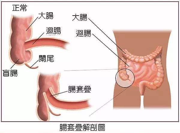 宝宝间断性哭闹是肠套叠吗,宝宝肠绞痛会一直哭闹吗