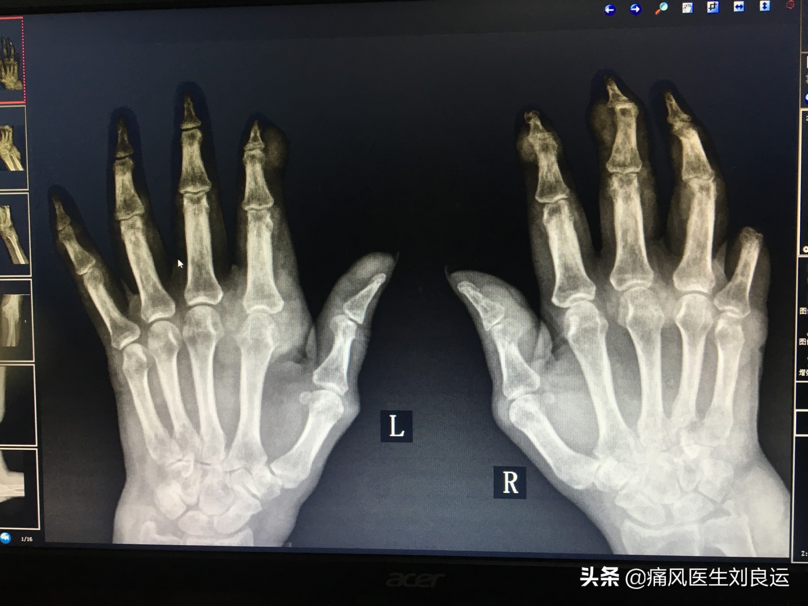 尿酸正常了可以手术取痛风石吗,痛风石可以做手术取掉吗