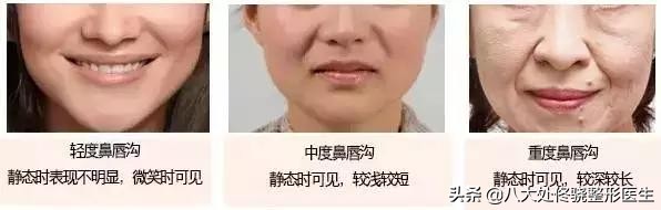 眼窝填充自体脂肪和玻尿酸哪个好,鼻唇沟凹陷物理改善方法