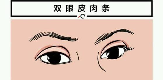 做完双眼皮为什么会有肉条感,做完双眼皮肉条感可以消除嘛