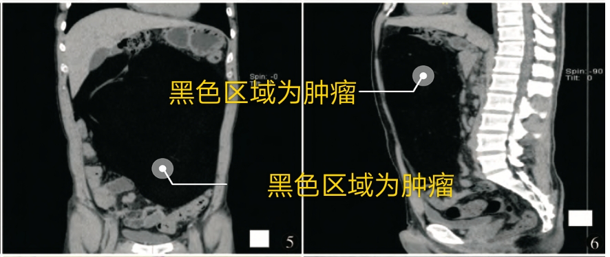 开腹腔切除肿瘤有危险吗 (腹腔内肿瘤割了又长)
