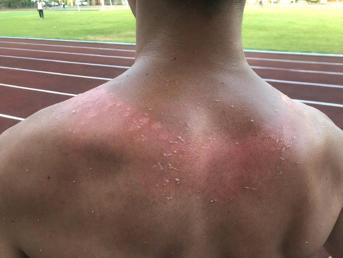 王栎鑫眼睛肿成悲伤蛙照片,王栎鑫晒照