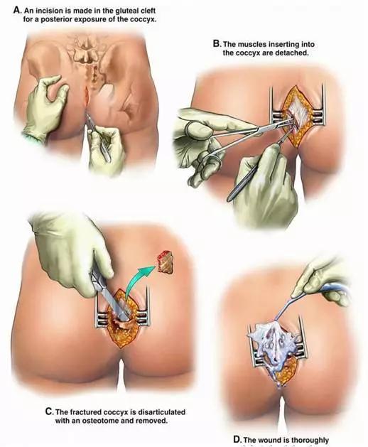 徐姑姑骨折完整版,徐姑姑骨折在第几集