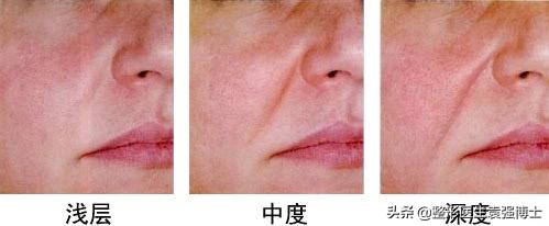 一招教你解决法令纹,这3种方法解决法令纹效果很惊艳