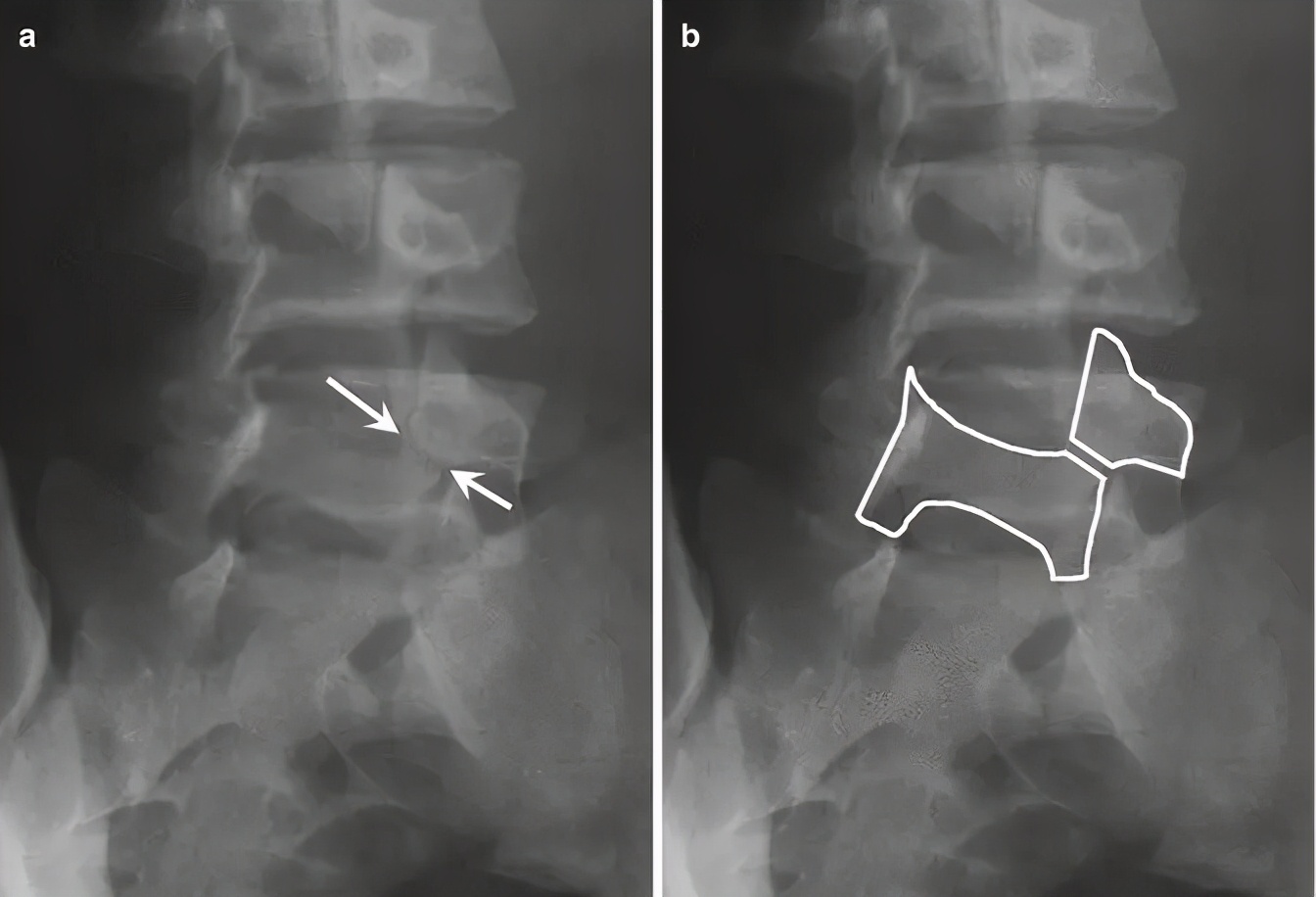 青少年一跑步就腰痛,青少年腰痛是什么原因引起的