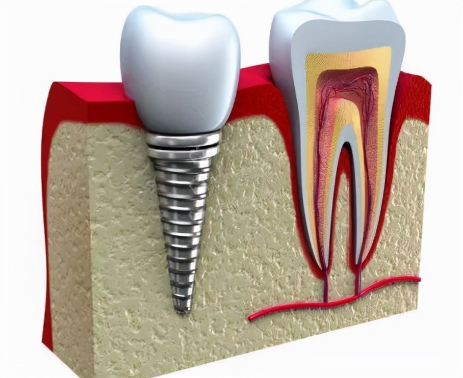 为什么种植牙的报价五花八门,市面上种牙价格五花八门