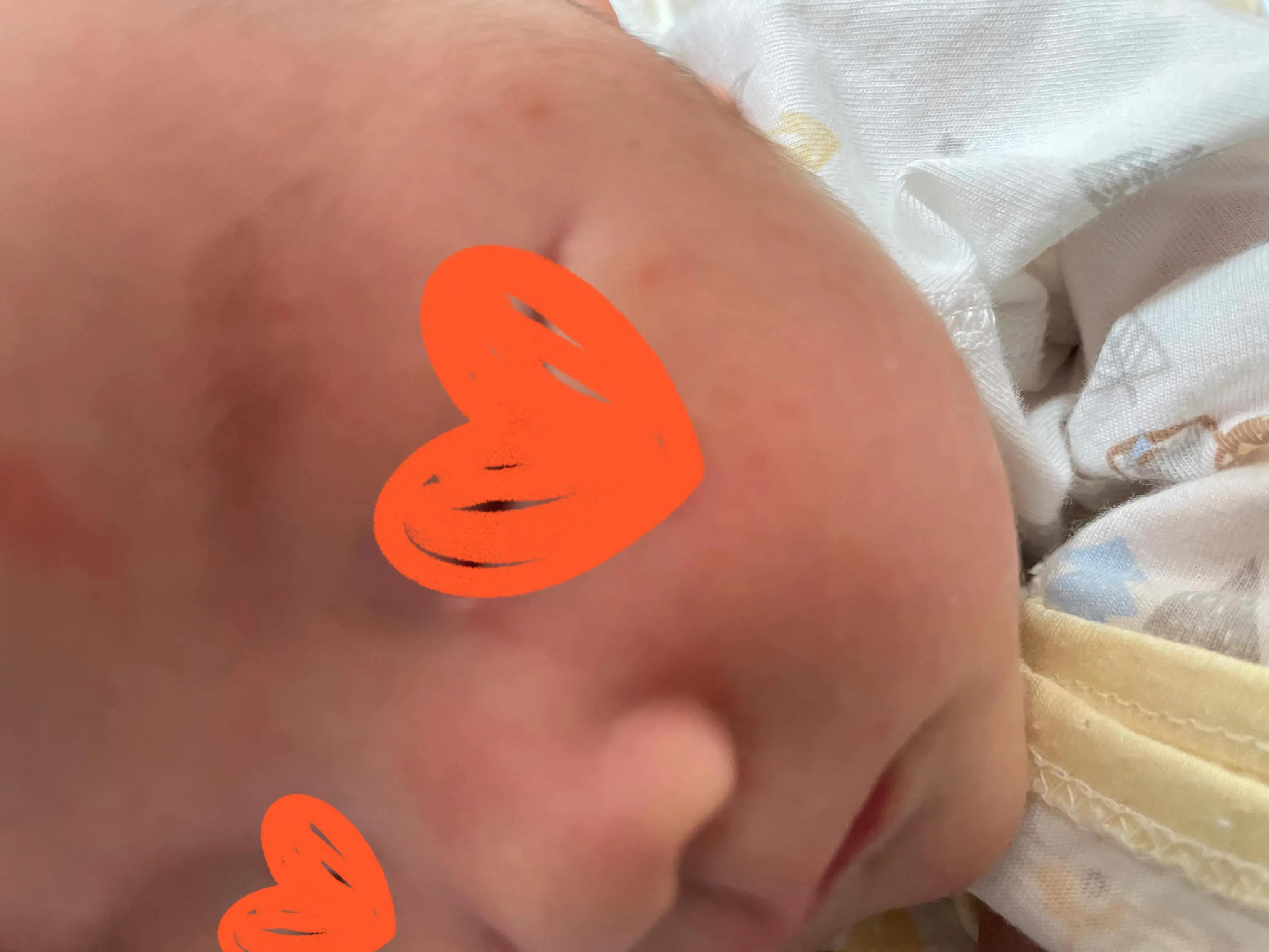 养宠物会不会造成孩子湿疹,宝宝湿疹跟家里养宠物有关系吗