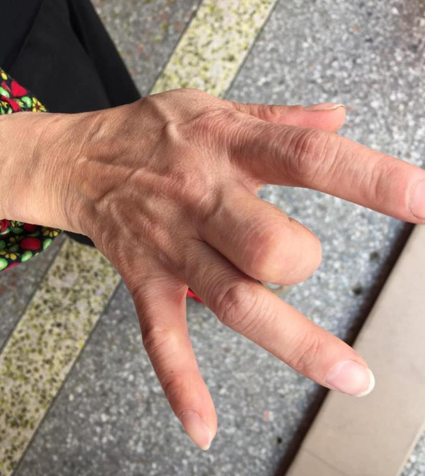 医生，我的手指为什么伸不直了
