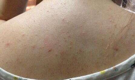 后背痘痘一堆,后背一大片痘痘多年没好