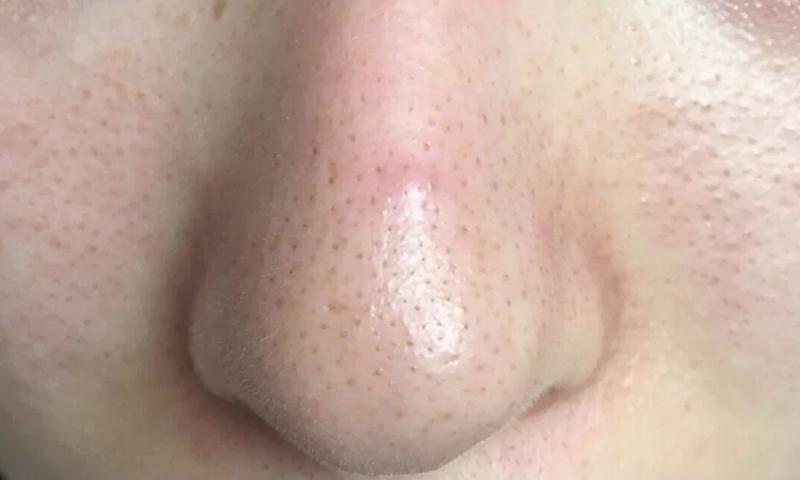 毛孔堵塞的原因,腿上汗毛堵塞在毛孔里是什么原因