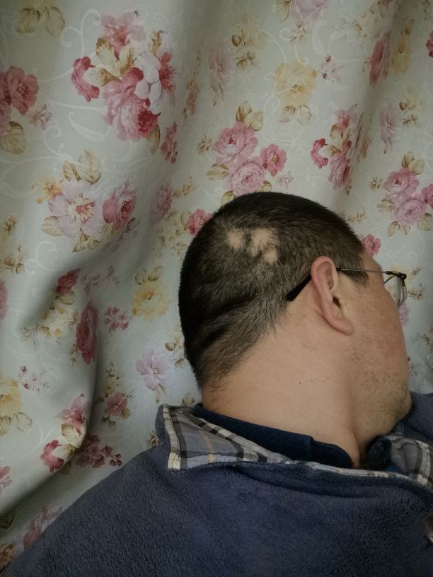 发现斑秃刚好又开始掉头发怎么办,突然发现斑秃怎么治疗