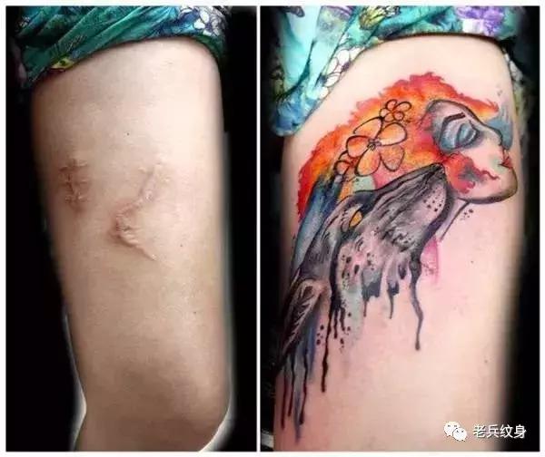 疤痕体质可以用纹身去遮盖疤痕吗,你的疤痕是什么颜色呢