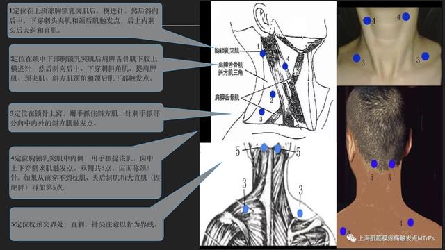 筋膜炎疼痛是因为不通才疼吗,大道至简治疼痛