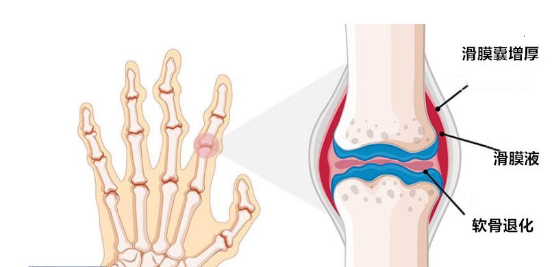 膝盖滑囊炎有何疼痛症状,膝盖滑囊炎的症状及治疗方法
