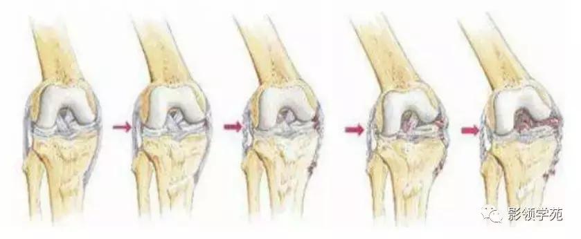 膝关节疼痛的问题各种各样的图片,膝关节疼痛的16种最常见原因速查