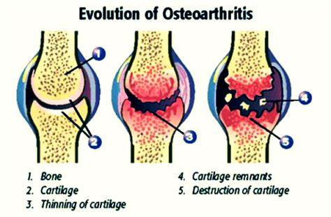 女性手部骨关节炎如何治疗,手部骨关节炎怎么治疗