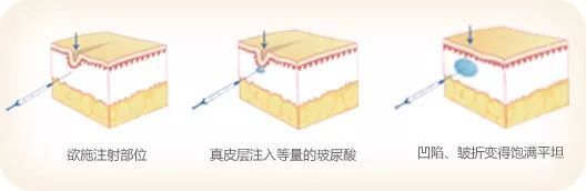 护肤品成分噱头,护肤成分透明质酸你了解多少
