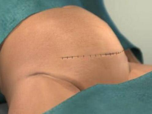 孕妇刀口祛疤痕哪个药膏好用,疤痕体质孕妇剖腹产后疤痕什么样