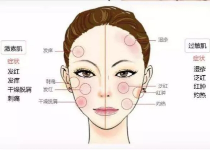 断激素后症状,什么叫断激素过敏反应