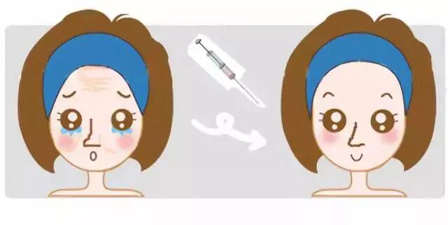 填充泪沟一个月了还有淤青,填充泪沟纹两年后脸肿