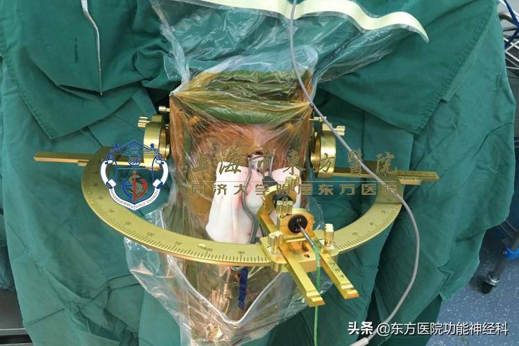 难治性精神病有必要外科手术吗,手术治疗精神病的成功率