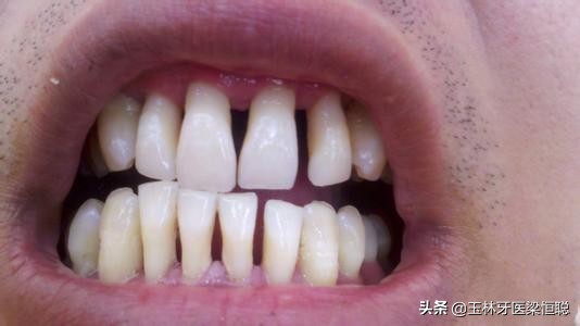 什么是牙周炎的临床表现,什么是牙周炎用什么药见效