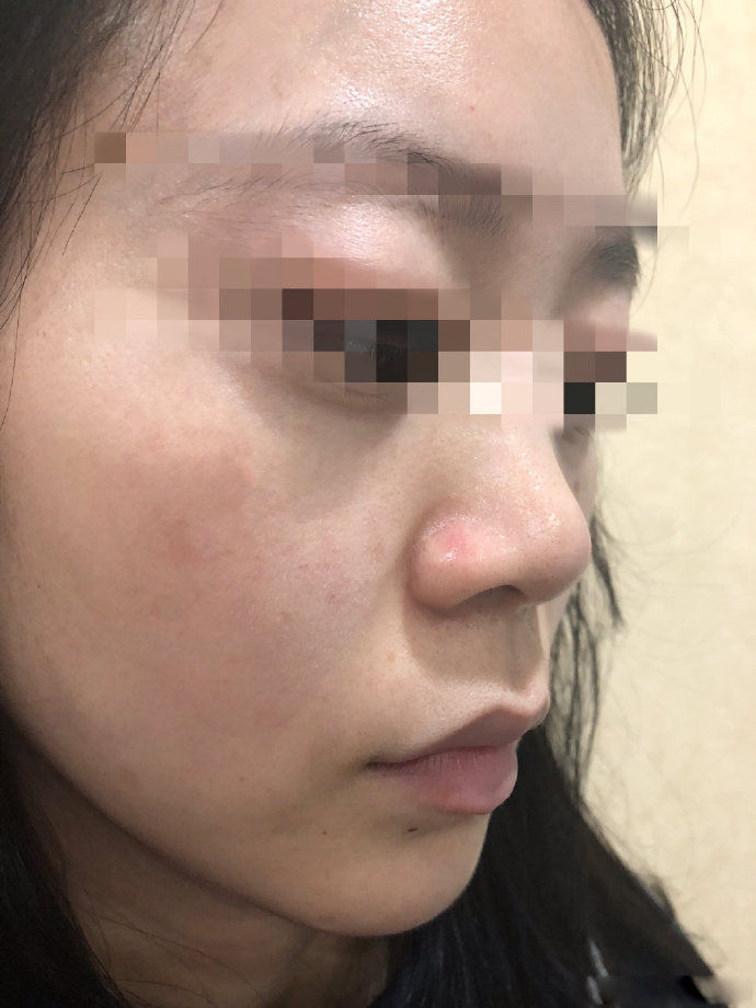 点阵激光能把伤疤完全修复吗,激光点阵可以修复到多少程度