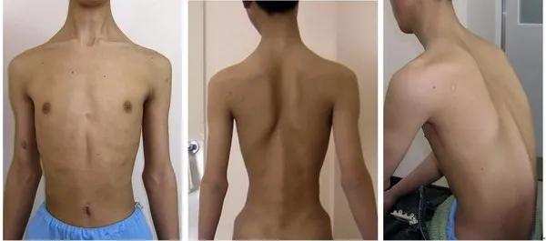 孕妇怎样检测进行性肌营养不良,进行性肌营养不良症孕期能查出吗