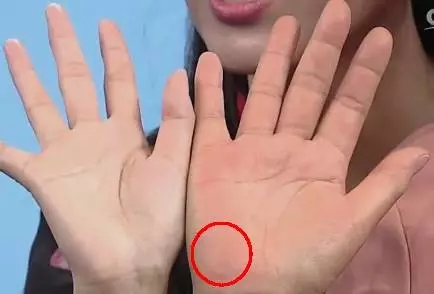 手的健康识别,看手识病疾病自测