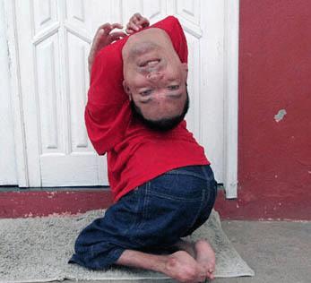 男子身体弯曲180度现状,男子头颅畸形