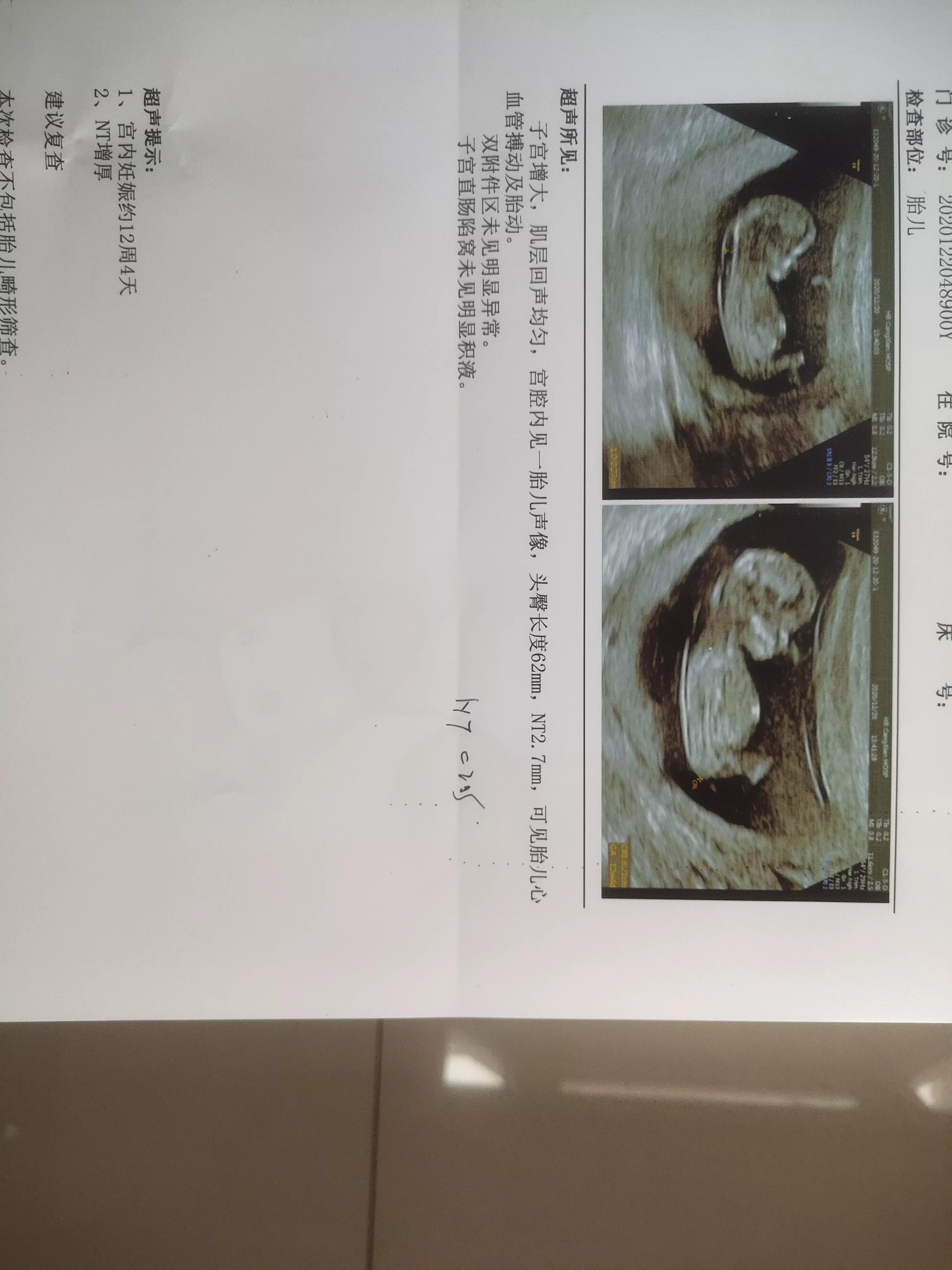 怀孕检查nt值超两倍怎么办,怀孕检查nt增厚