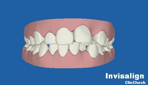 隐形牙套的效果和钢牙效果一样吗,传统牙套和隐形牙套哪个效果好