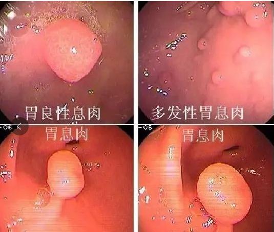 胃息肉一定要切除吗有危险吗,为什么胃息肉不建议切除