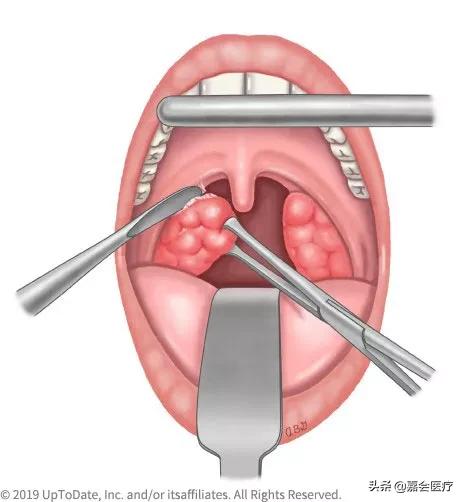 治好打鼾其实很简单的,通过手术能彻底治好打鼾吗