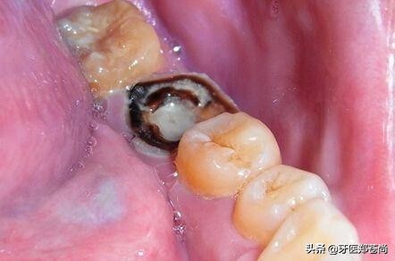 有蛀牙牙的中间有个小洞怎么办,有个蛀牙疼怎么办呢