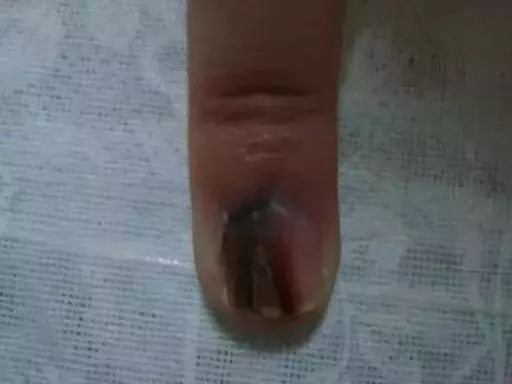 指甲上月牙少是什么问题,指甲月牙少了怎么回事