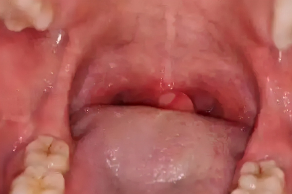 反复口腔溃疡竟被查出癌症,深圳男子口腔溃疡导致舌癌