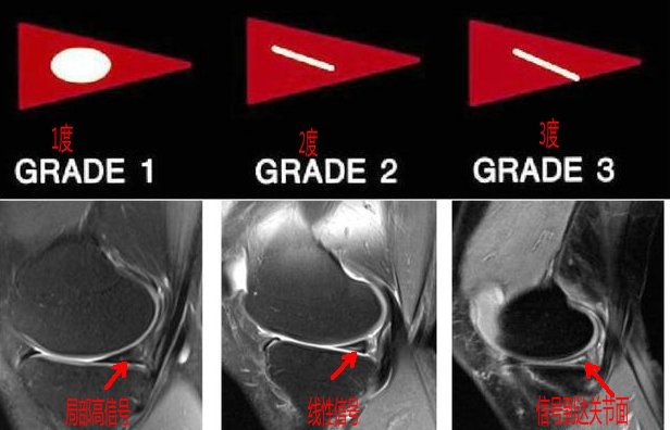 磁共振检查半月板损伤有误诊率吗,半月板磁共振会不会有误诊