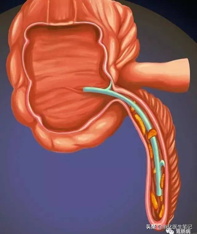 阑尾炎不开刀吃什么药好得快,阑尾炎开刀好还是保守治疗