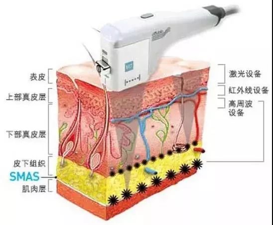 超声刀会使脸变得特饱满,超声刀能抚平皱纹吗