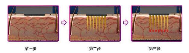 从零开始学光电美容,医院光电美容能做吗